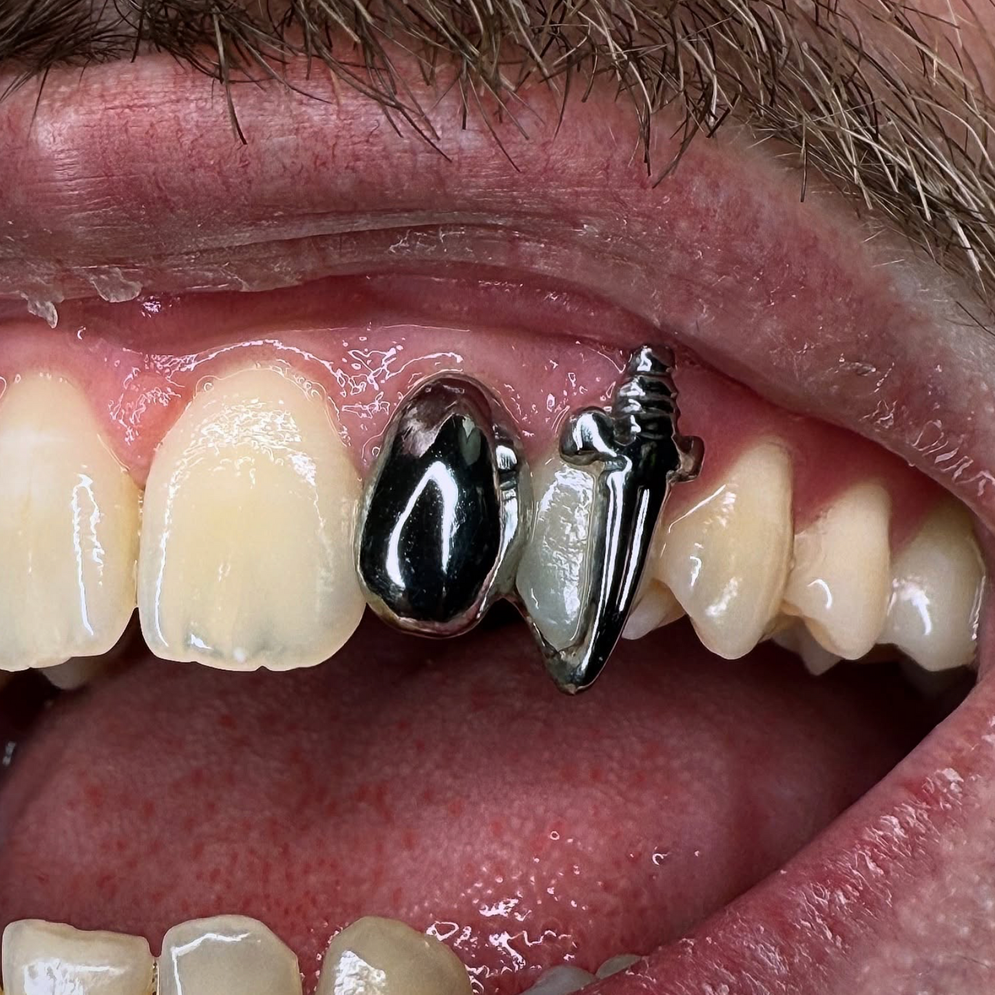 GRILLZ DAGUES + GRILLZ CLASSIQUE