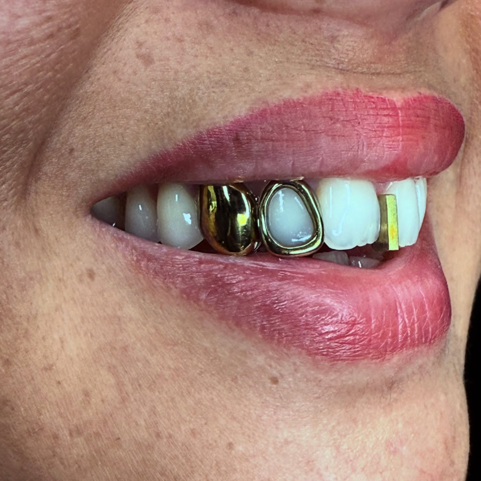 GRILLZ TITANE "GOLD EFFECT"